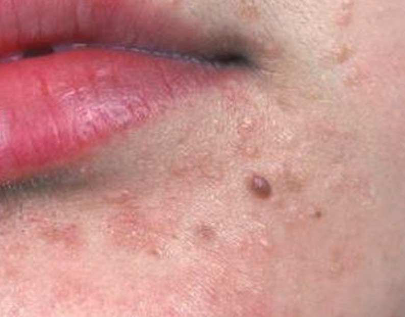 flat-warts-on-face-pictures-treatment-causes-removal