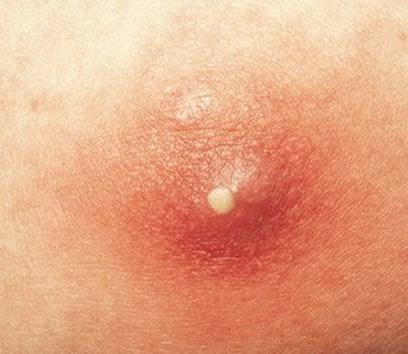 pimples infection