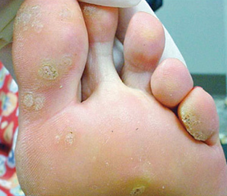 What Is Wart On Foot