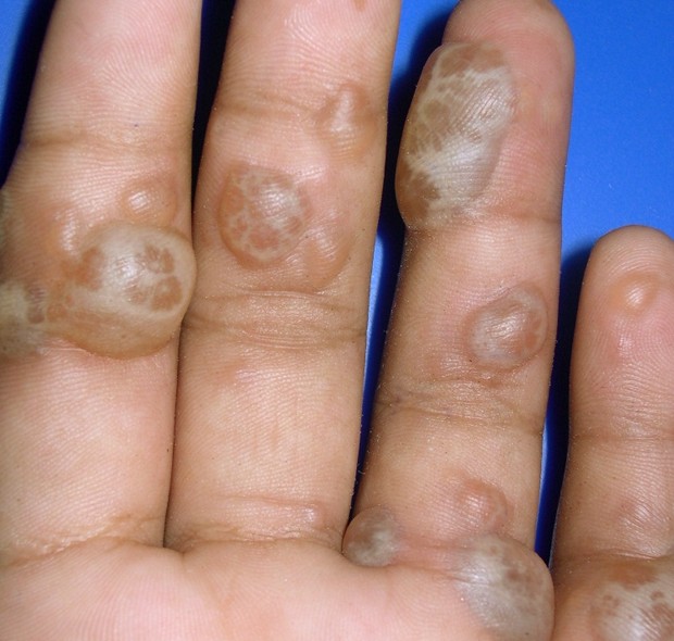 blisters on hands pictures