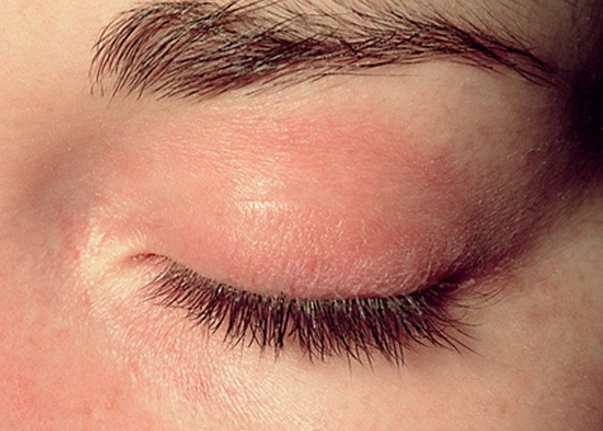 Red Rash On Eyelids Images And Photos Finder 