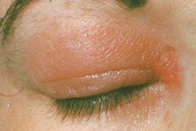 Rash On Eyelid Pictures Causes And Treatment 