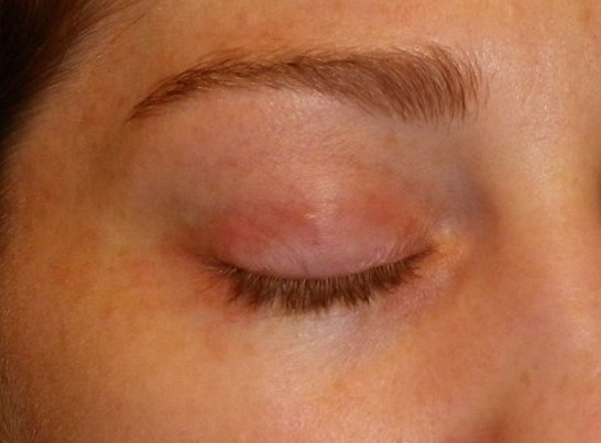 rashes on eyelid