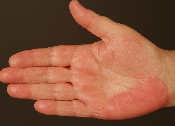 Itchy Hands and Feet | MD-Health.com