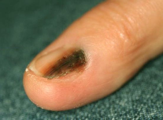 nail bed melanoma #11
