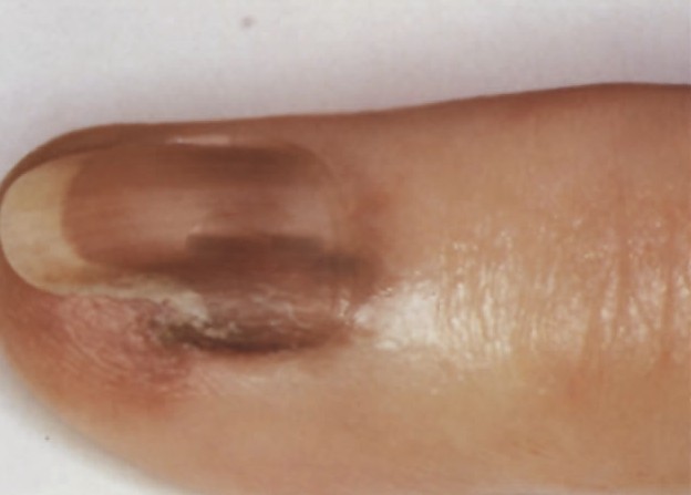 subungual melanoma picture