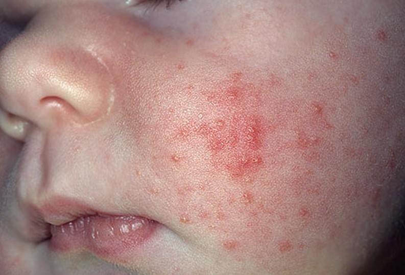 What To Do For Baby Viral Rash at Barbara Lindsey blog