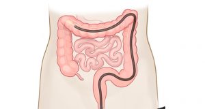 colonoscopy