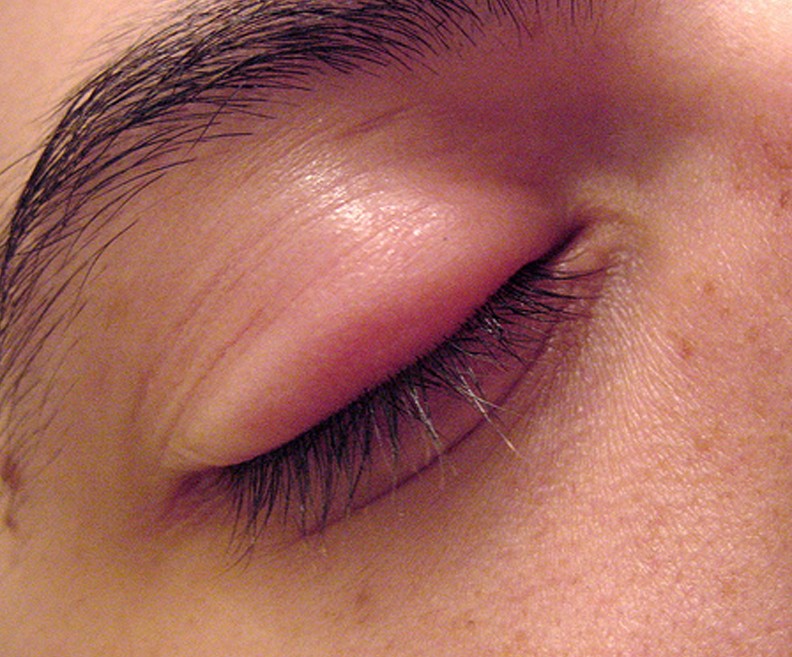 eye-stye-medical-point