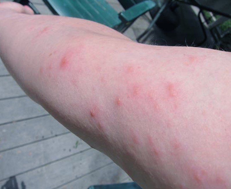 poison ivy rash pictures