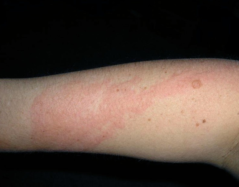 poison ivy rash pictures