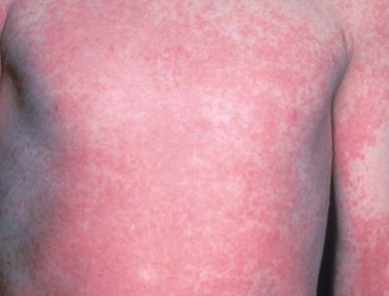 fever how to reduce rash scarlet Rash,  Pictures, Symptoms, Contagious Scarlet Fever