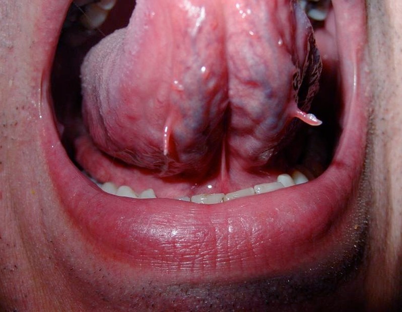 warts on tongue pictures