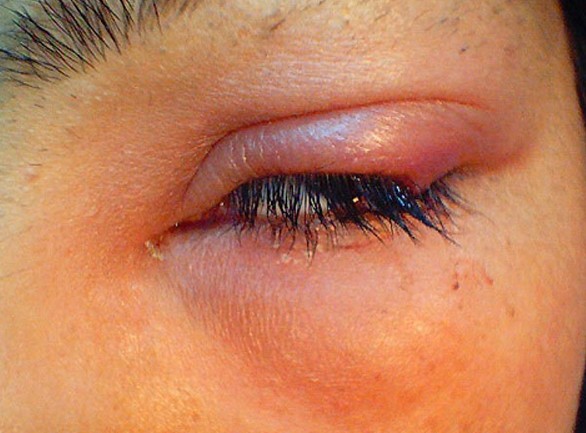 Swollen Eyelid