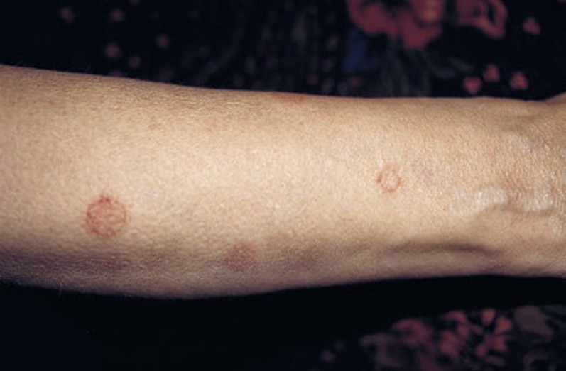 Nummular Eczema - Pictures, Symptoms, Treatment, Causes