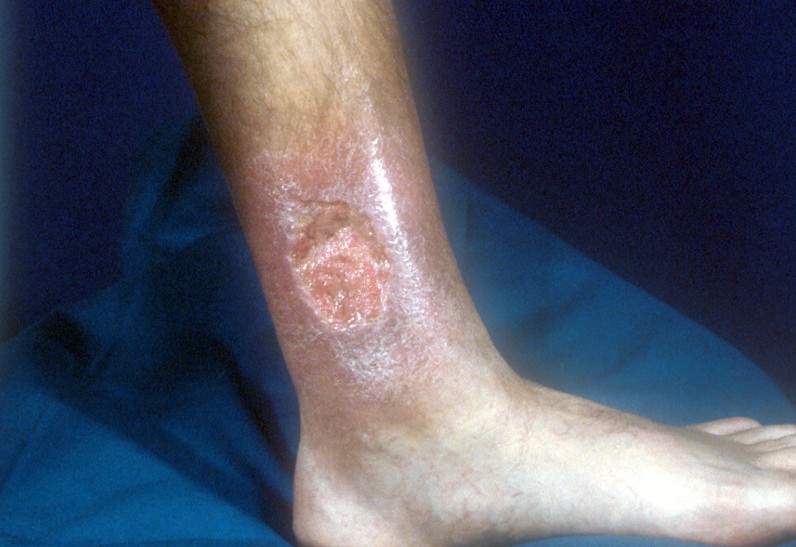 Pyoderma Gangrenosum Medical Point