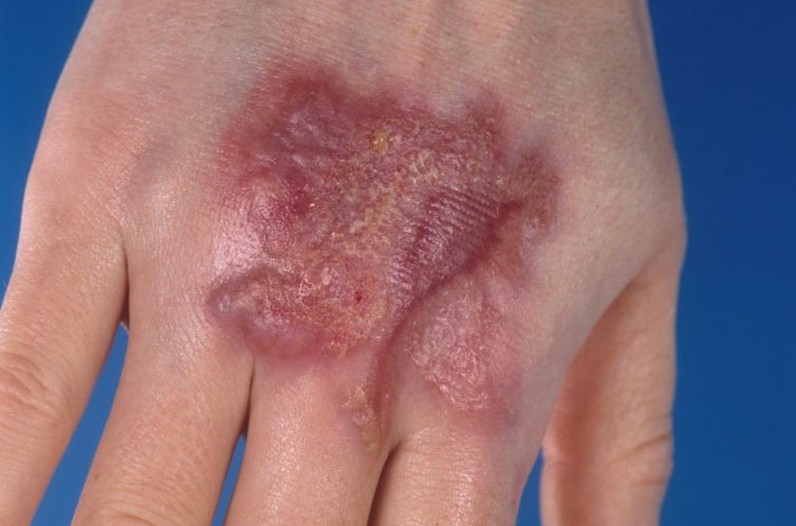 Pyoderma Gangrenosum | Medical Point