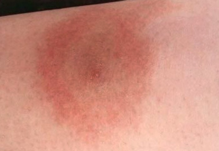 erythema migrans