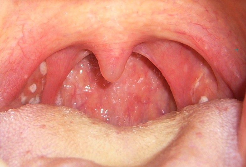 white spot on tonsils
