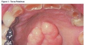 Torus Palatinus